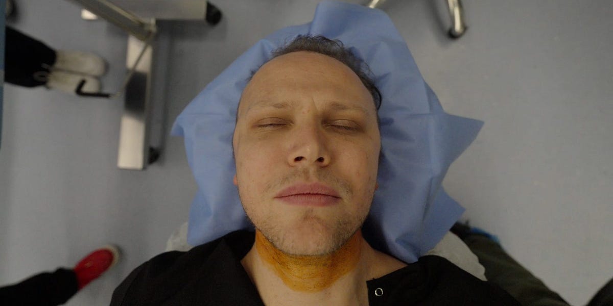 I Went to Istanbul, Turkey for a $3,500 Hair Transplant - Business Insider